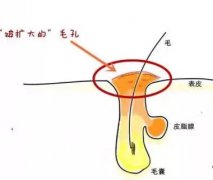 【太原欧美莲】毛孔粗大是怎么形成的？